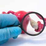 امید تازه برای زنان مبتلا به تخمدان پلی‌کیستیک/تغذیه‌ای که افسردگی را کاهش می‌دهد