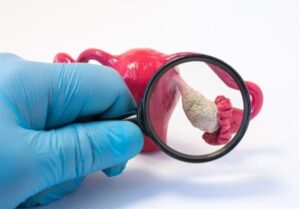 امید تازه برای زنان مبتلا به تخمدان پلی‌کیستیک/تغذیه‌ای که افسردگی را کاهش می‌دهد