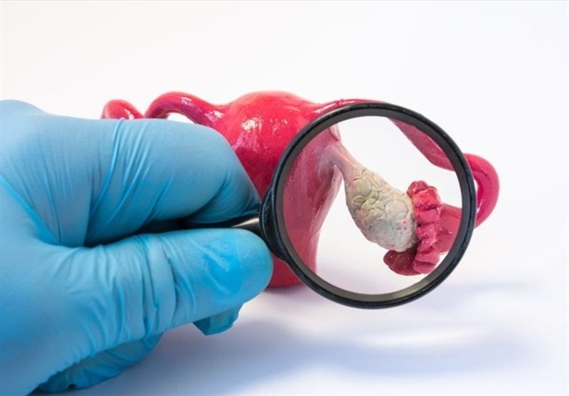 امید تازه برای زنان مبتلا به تخمدان پلی‌کیستیک/تغذیه‌ای که افسردگی را کاهش می‌دهد