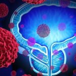 سرطان پروستات؛ تهدید خاموش مردان/تأکید بر غربالگری از 50 سالگی