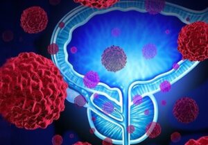 سرطان پروستات؛ تهدید خاموش مردان/تأکید بر غربالگری از 50 سالگی